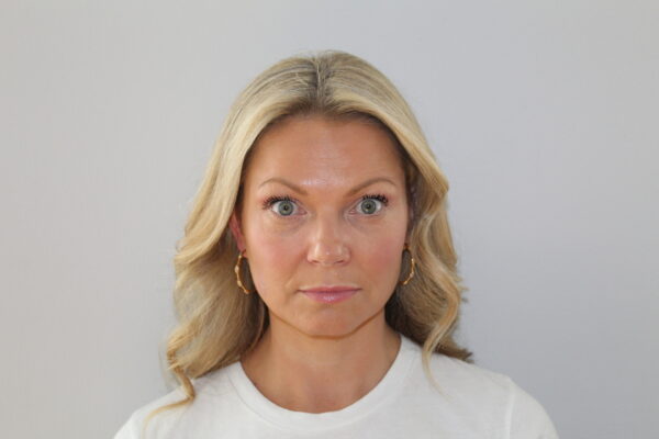 Botox after
