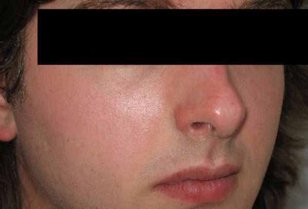 After treatment
