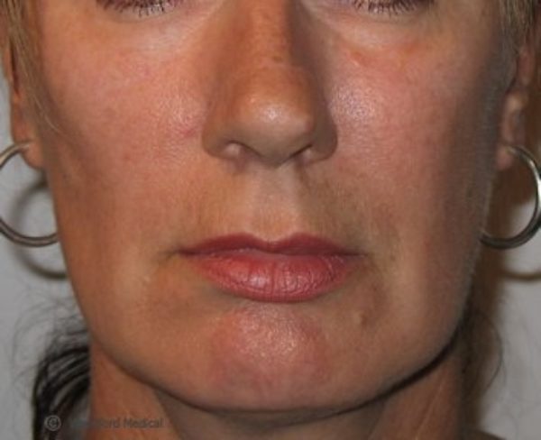 Dermal filler - after treatment