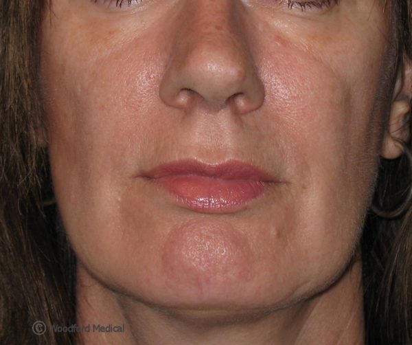Dermal Filler - before treatment
