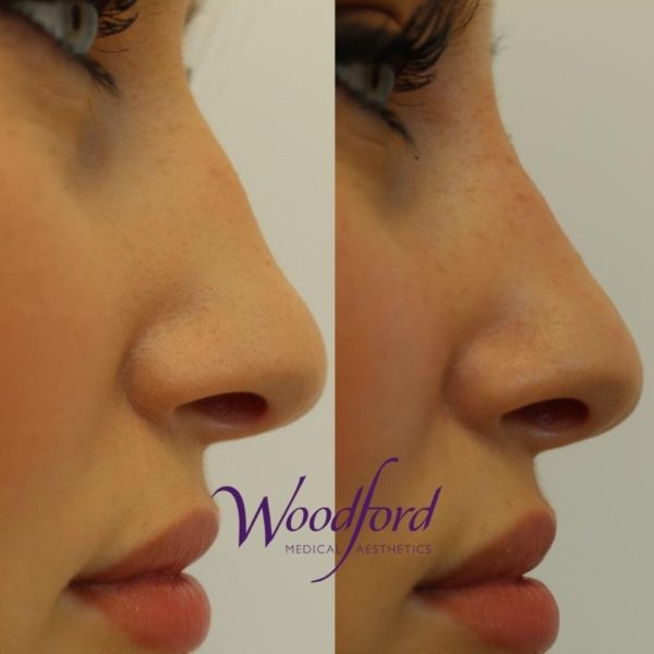 Before and After Nose Procedure