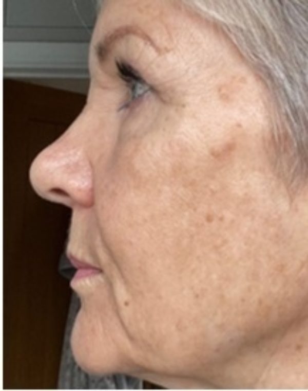 BBL Laser Pigmentation 7 Days Post Treatment at Woodford Medical