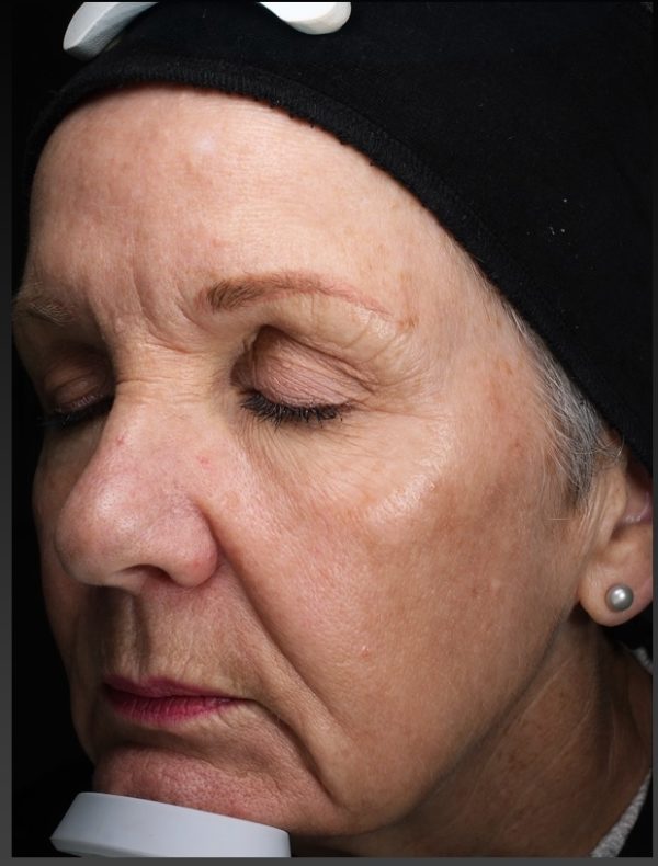After BBL Laser Treatment