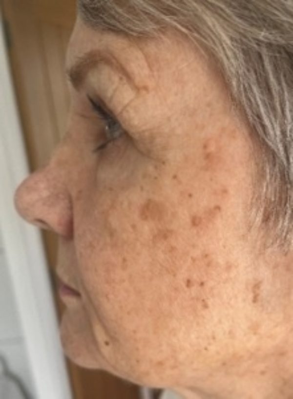 BBL Laser Pigmentation Before at Woodford Medical