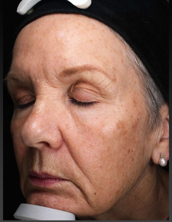 Before BBL Laser Treatment