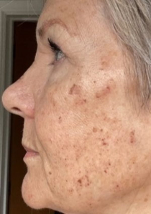 BBL Laser Pigmentation Post Treatment Side Effects