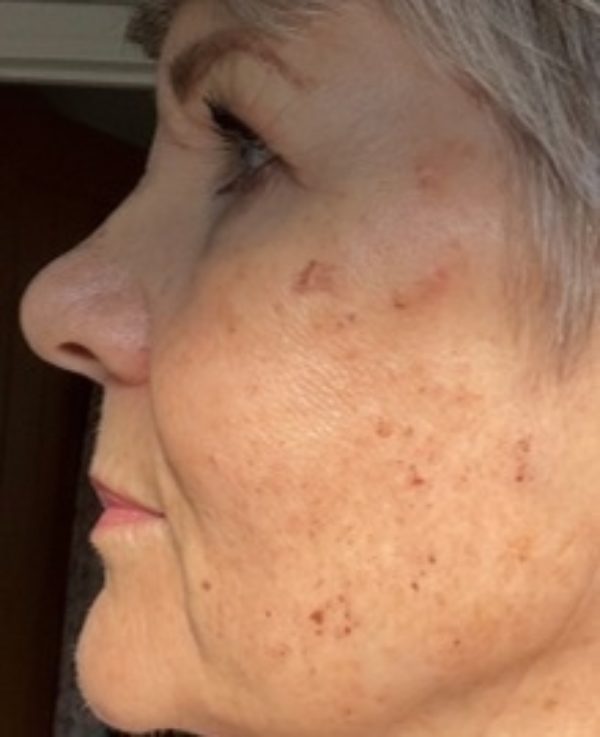 BBL Laser Pigmentation Recovery at Woodford Medical