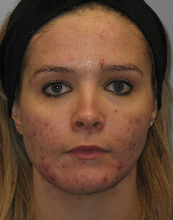 Before treatment