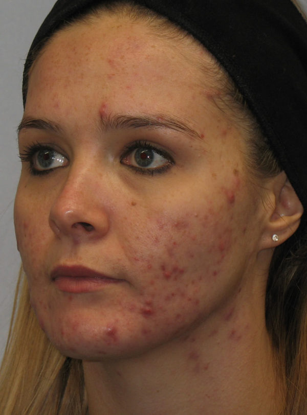 Before treatment