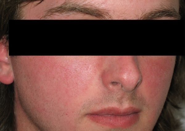 Before treatment