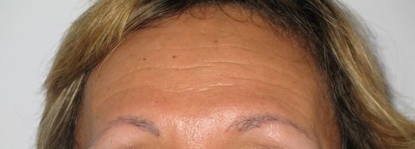 Botox before