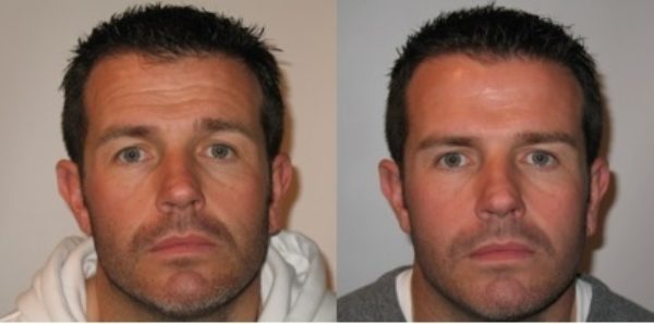 Before and after botox treatment