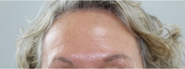 Botox after