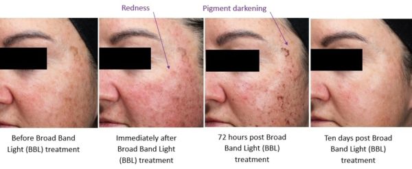 BBL Broad Band Light Side Effects Pigmentation