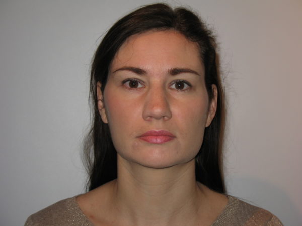 Botox Bruxism - after treatment