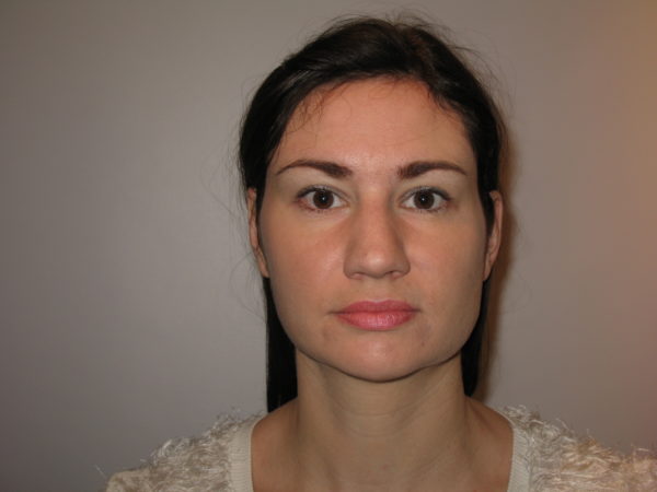 Botox bruxism - before treatment