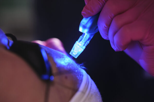 JetPeel treatment at Woodford Medical
