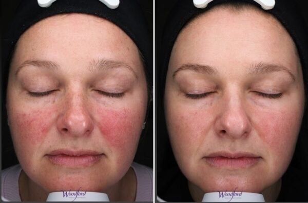 Rosacea treatment woodford medical