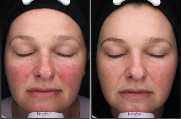 Before and after BBL/Moxi laser
