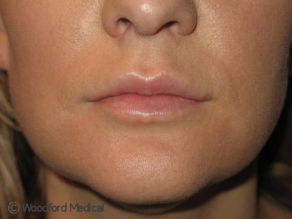 Lip filler - after treatment