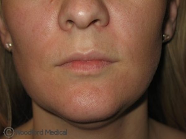 Lip filler - before treatment