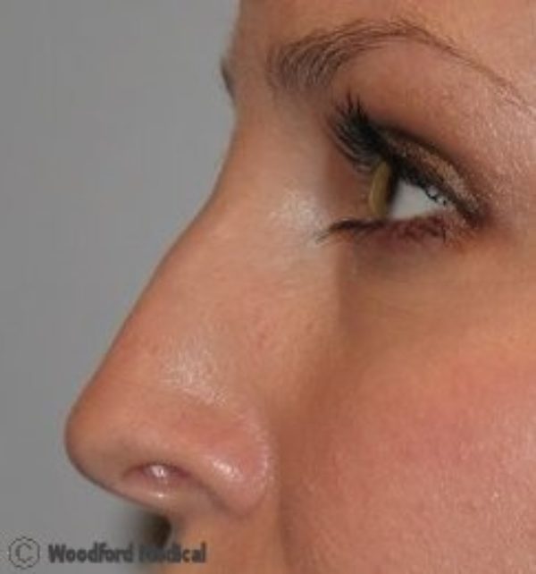 Dermal Filler nose - after treatment