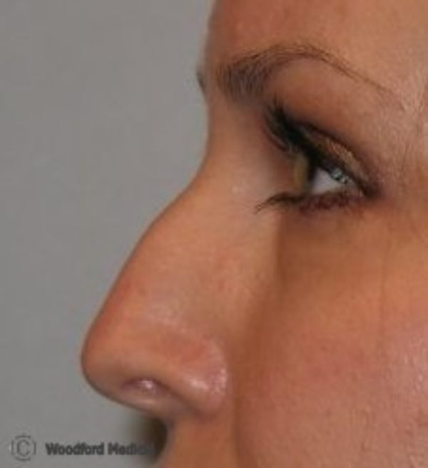 Dermal filler nose - before treatment