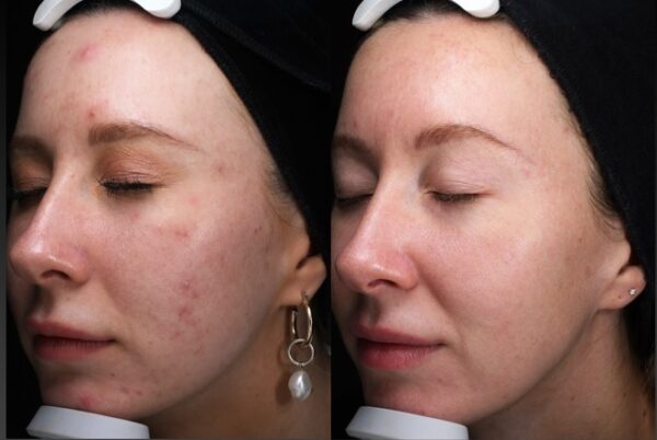 Acne before and after Woodford Medical