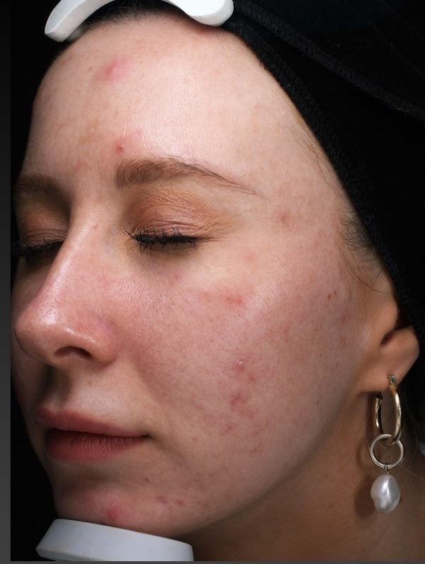 Visia image Dorothy before treatment