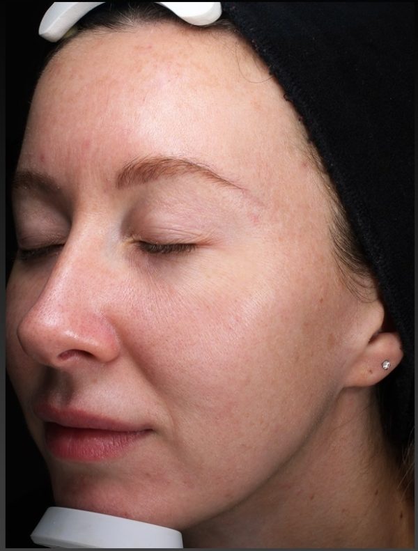 Visia image Dorothy after treatment