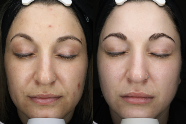 UltraClear 3D Miracl before and after