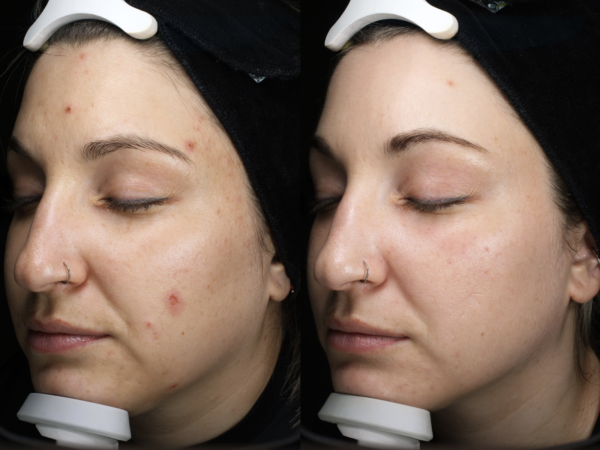 Kerys before and after