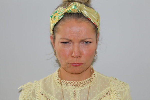 Botox before