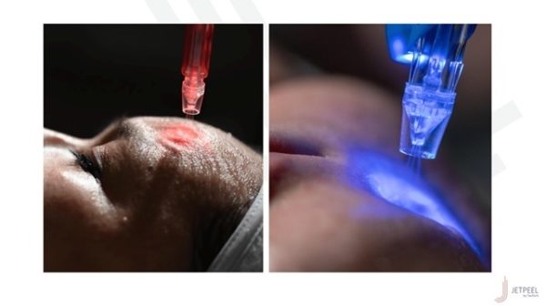 The Jet Peel at Woodford Medical