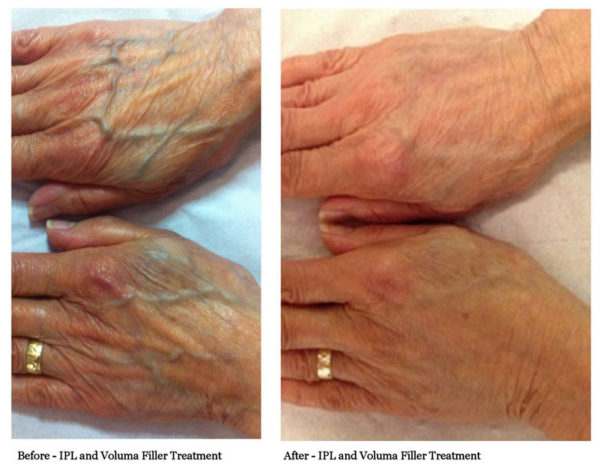 Juvederm Voluma before and after