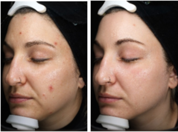 3D miracl Before and After