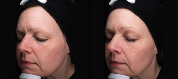 Before and After DermaFrac treatment