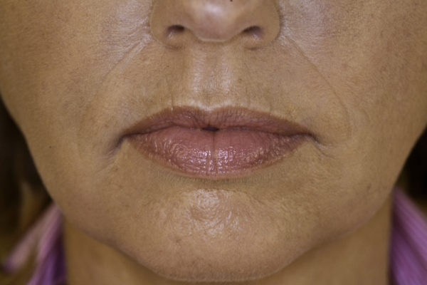 Dermal Filler used to reduce Marionette lines at Woodford Medical (after)