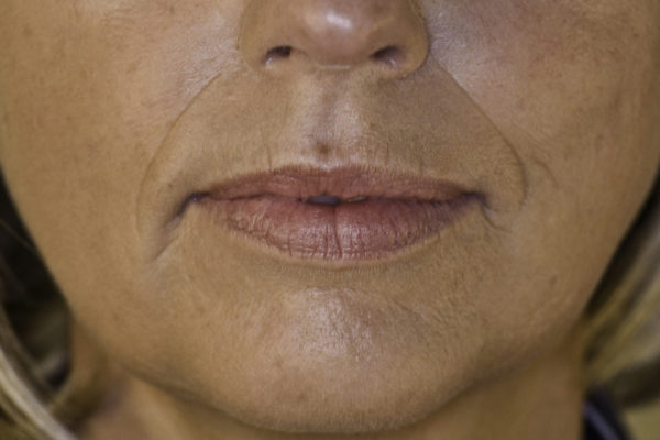 Dermal Filler used to reduce Marionette lines at Woodford Medical (before)