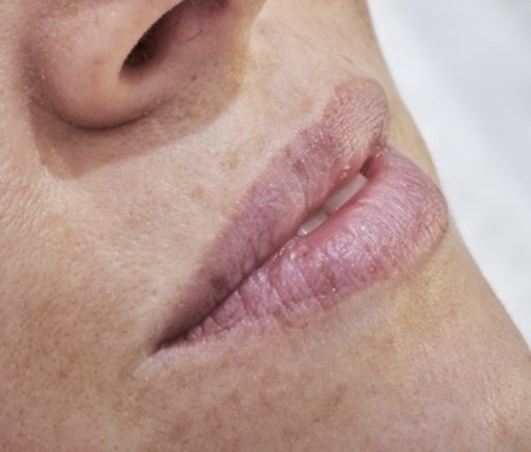 Love those Lips at Woodford Medical