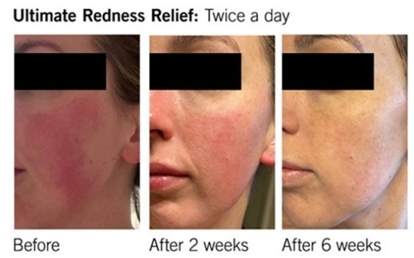 Neova Ultimate Redness Relief Results