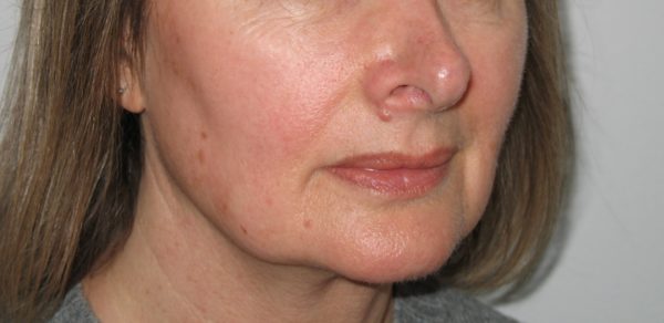 A lady's face ftera pigmentation treatment