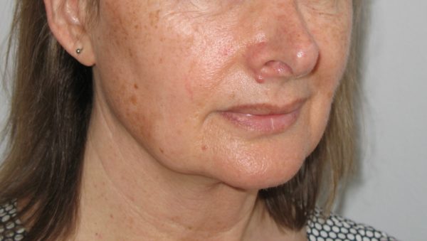A lady's face before pigmentation treatment