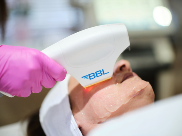 Patient being treated for Rosacea with BBL