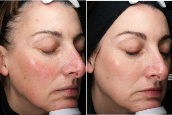 Treatment for Rosacea at Woodford Medical