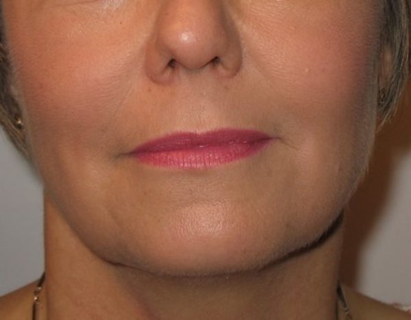 Dermal Filler Voluma - after treatment