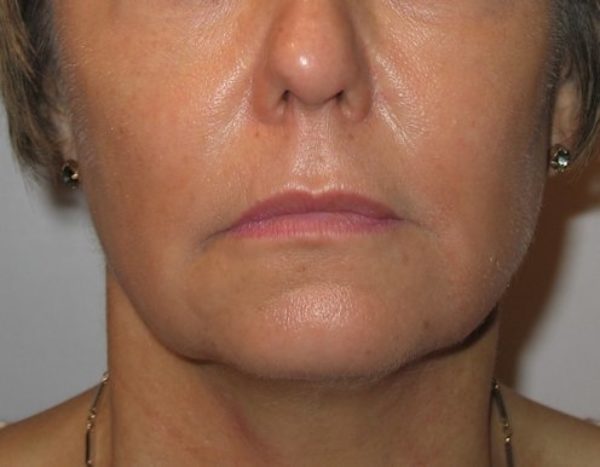 Dermal Filler Voluma - before treatment