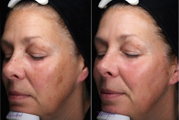 Before and after BBL/Moxi laser treatment
