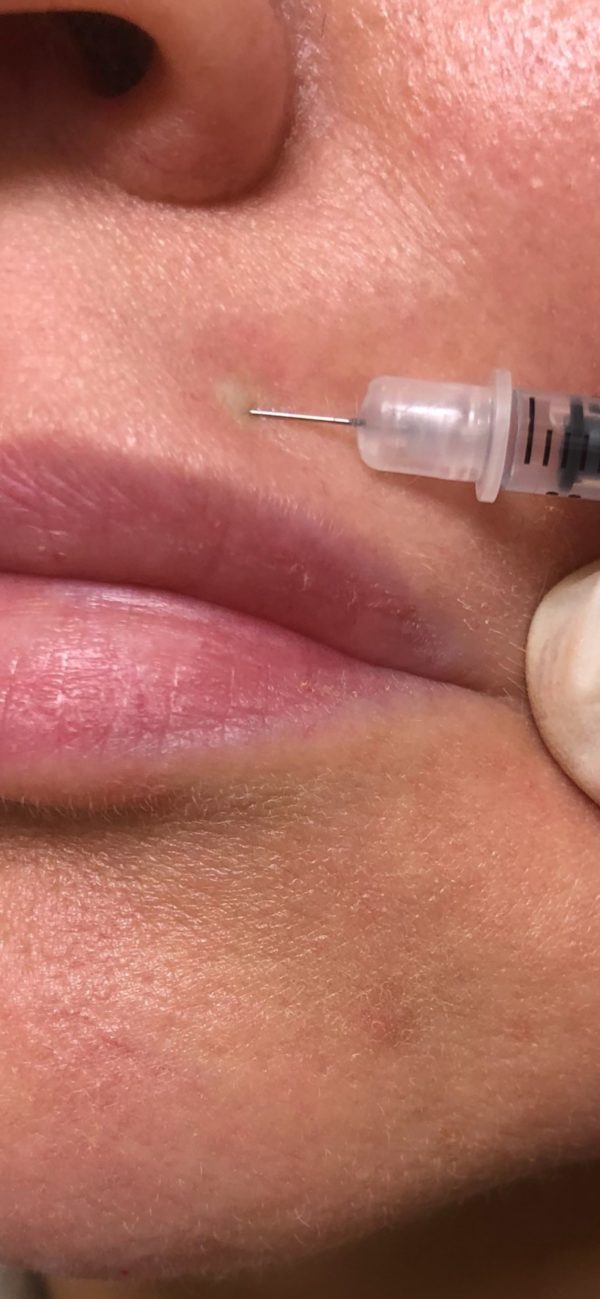 lip flip close up