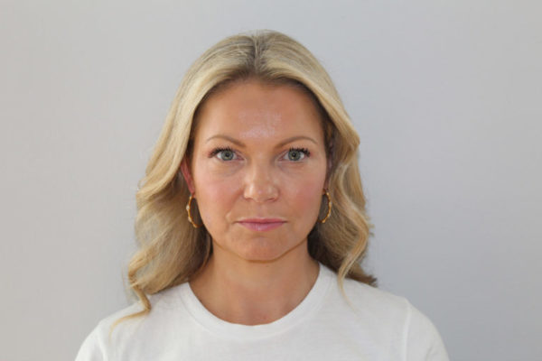botox after